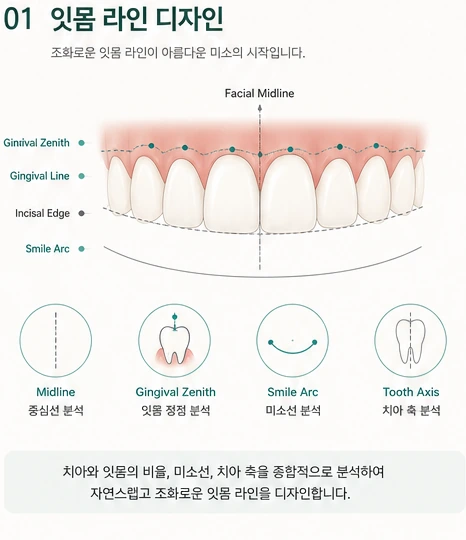 잇몸 라인 디자인 참고 도해 — 얼굴 정중선, 잇몸 정점, 잇몸 경계선, 절단연, 미소선