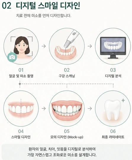 디지털 스마일 디자인 6단계 참고 도해 — 촬영, 스캐닝, 분석, 디자인, 모의 디자인, 최종 라미네이트