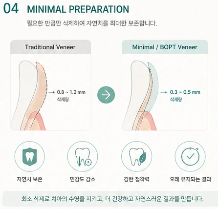삭제량 참고 도해 — 기존 베니어 0.8~1.2mm 와 최소 삭제 0.3~0.5mm 비교