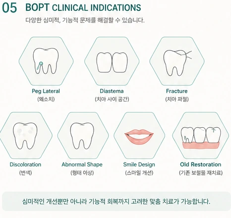 적응증 참고 도해 — 왜소치, 치아 사이 공간, 파절, 변색, 형태 이상, 스마일 개선, 기존 보철물 재치료