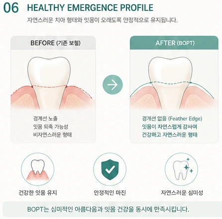 Emergence Profile 참고 도해 — 기존 보철과 BOPT 적용 시 잇몸 형태 비교